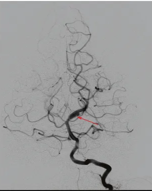 Fig. 47.3 Left vertebral artery angiography shows a dissecting aneurysm involving the proximal left posterior cerebral artery. 