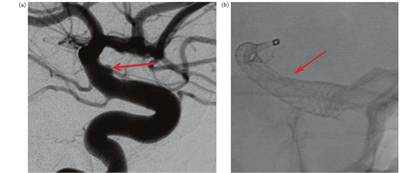 vu Fig. 47.4 This 30-year-old woman presented with diffuse SAH. Catheter angiography shows a blister-like aneurysm (a) involving the supraclinoid portion of the right ICA (arrow). (B) The blister-like aneurysm was treated with a flow diverter (arrow). 