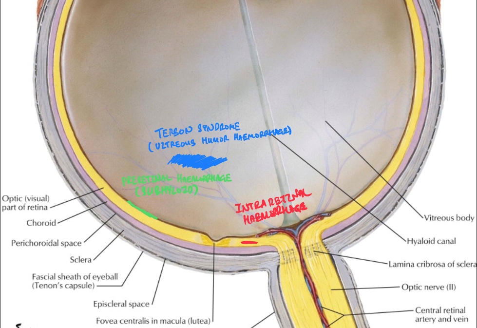 Optic (visual) part of retina Choroid Perichoroidal space Sclera Fascial sheath of eyeball (Tenon's capsule) Episclcral space Fovea centralis in macula (lutea) Vitreous body Hyaloid canal Lamina cribrosa Of sclerd Optic nerve (Il) Central retinal artery and vein 