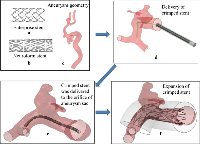 Diagram of an aneurysm stent AI-generated content may be incorrect.