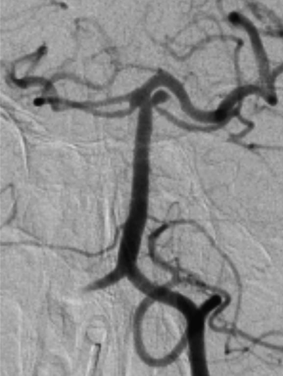 A close-up of an angiography AI-generated content may be incorrect.