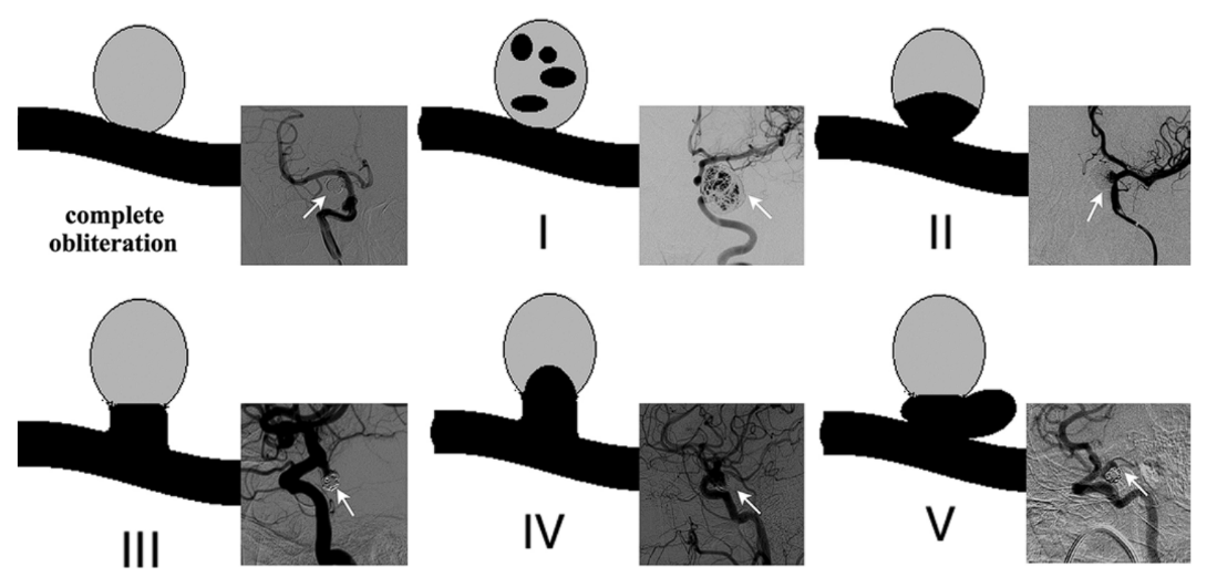 obliteration complete 