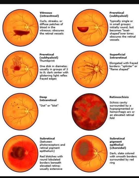 •Doe or • blot" (between and retinal pigment borders elevated retina; usually extenßve Typically Single in small groups; initially round , but shaped time ; obscures the retinal Intra retinal with frayed shaped¯ isiS cavity surrounded by a hy popig m or hemorrhagic or an elevated r«inal e pith Dark. slate colored smooth by red 