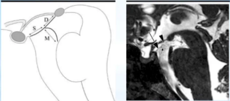 THREE SEGMENTS OF THE LILIEQUIST MEMBRANE It is formed by either a single or double arachnoid layer and divided into three segments. Sellar, Diencephalic and Nlesencephalic segments 