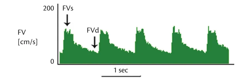 Transcranial Doppler. Indicative waveform from insonation of the middle cerebral artery using transcranial Doppler. The systolic and diastolic flow velocities (FV) are marked. The FVs is used to gauge the progression of vascular spasm or to quantify the Lindegaard ratio