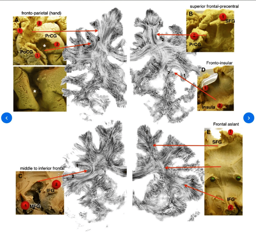 Coronal slices of the 'Digital Dejerine' maps and post-mortem blunt dissections of the corresponding tracts. (A) Fronto-parietal U-tracts of the hand region connecting precentral gyrus (PrCG) with post-central gyrus (PoCG). The asterisks in the top left images indicate the correspondence between the presence of protuberances from the wall of the central sulcus and the underlying U-shaped tract. (B) U-shaped tracts connecting the PrCG with superior frontal gyrus (SFG). (C) Connections between the middle frontal gyrus (MFG) and inferior frontal gyrus (IFG). (D) Fronto-insular connections. (E) The frontal aslant tract (FAT) connecting inferior and superior frontal gyri.
