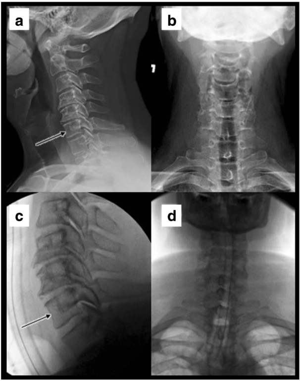 Pre-operative and intra-operative X-rays demonstrating positioning for a patient that underwent a cervical disc
arthroplasty at C6–7. a, b The lateral and A/P upright X-rays acquired prior to surgery, respectively; the arrow is pointing to C6. c, d Intraoperative lateral and A/P X-rays reproducing the same alignment as shown in a and b