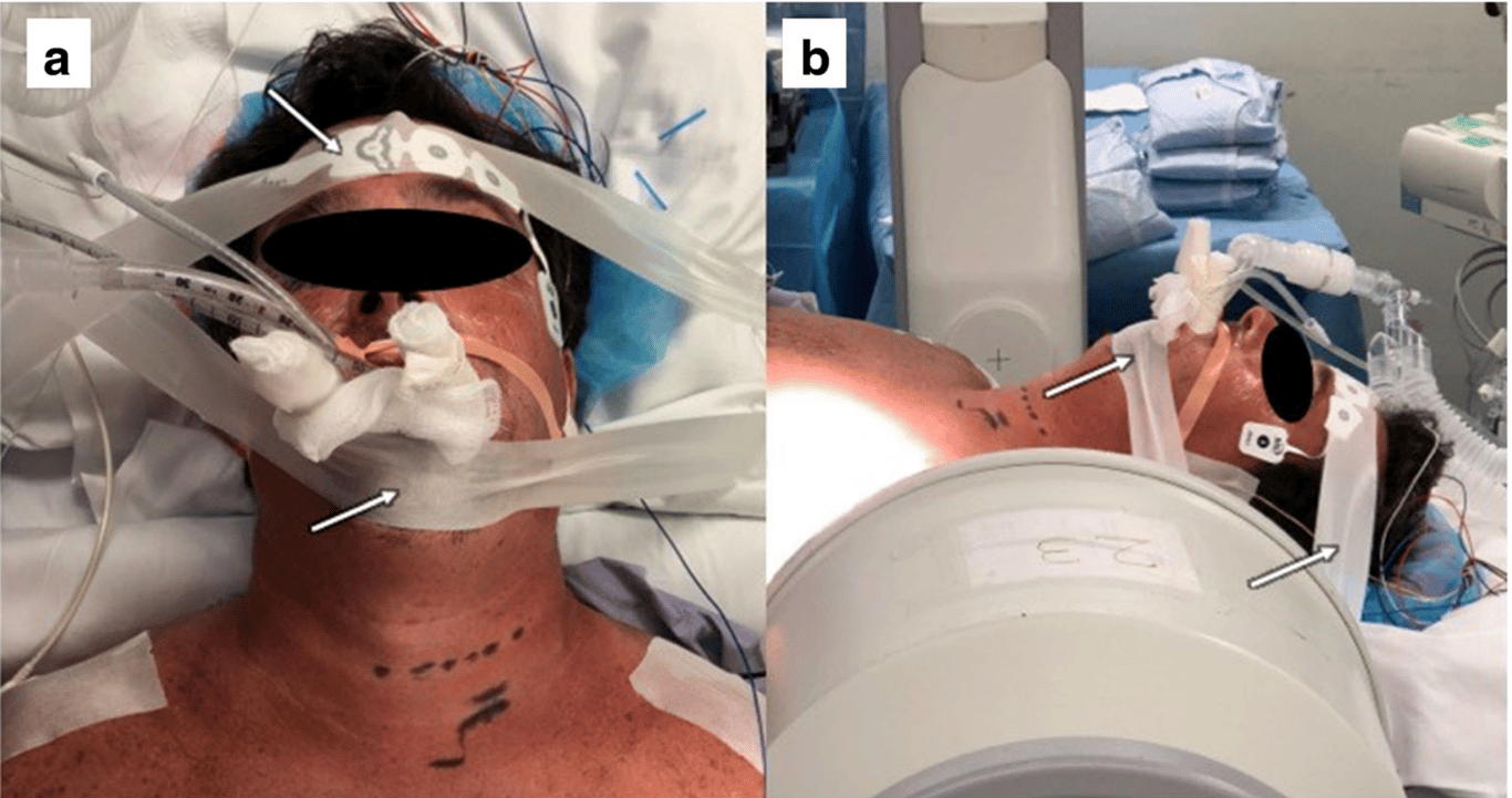 Tape should then be used over the forehead, across the chin, and also above the lip if needed to ensure that the positioning is maintained throughout the case
