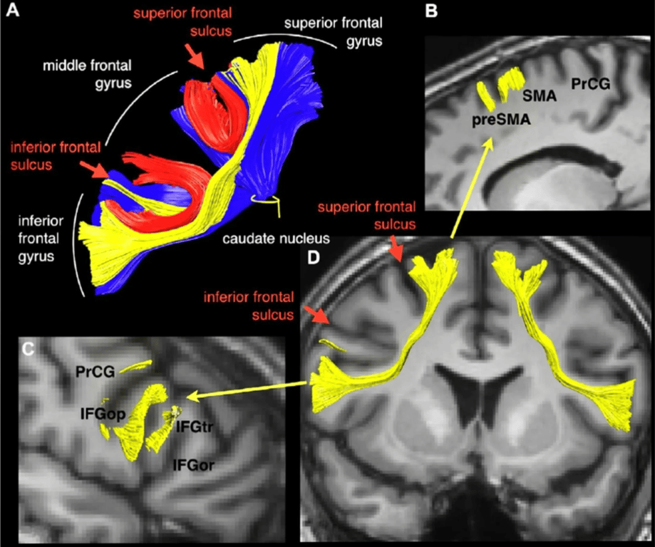 (A) Connections of the premotor regions of the frontal lobe. The frontal aslant tract (FAT) (yellow) connects the (B) dorsal and medial (supplementary and pre-supplementary motor area, SMA and pre-SMA) cortex of the SFG with the (C) posterior region of IFG. Red U-shaped tracts connect the superior and middle frontal gyri and the inferior and middle frontal gyri. Blue projection fibres connect the cortical premotor regions with the head of the caudate nucleus. (D) The frontal aslant is a bilateral tract.