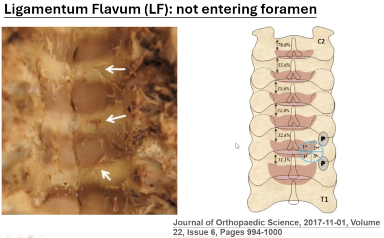 When performing a foraminotomy you do not need to enter the flavum as it does not cover the nerve root. 
Make sure to drill away the inferior and then superior articulating facet at the 3rd quadrant, where the nerve root lies. 