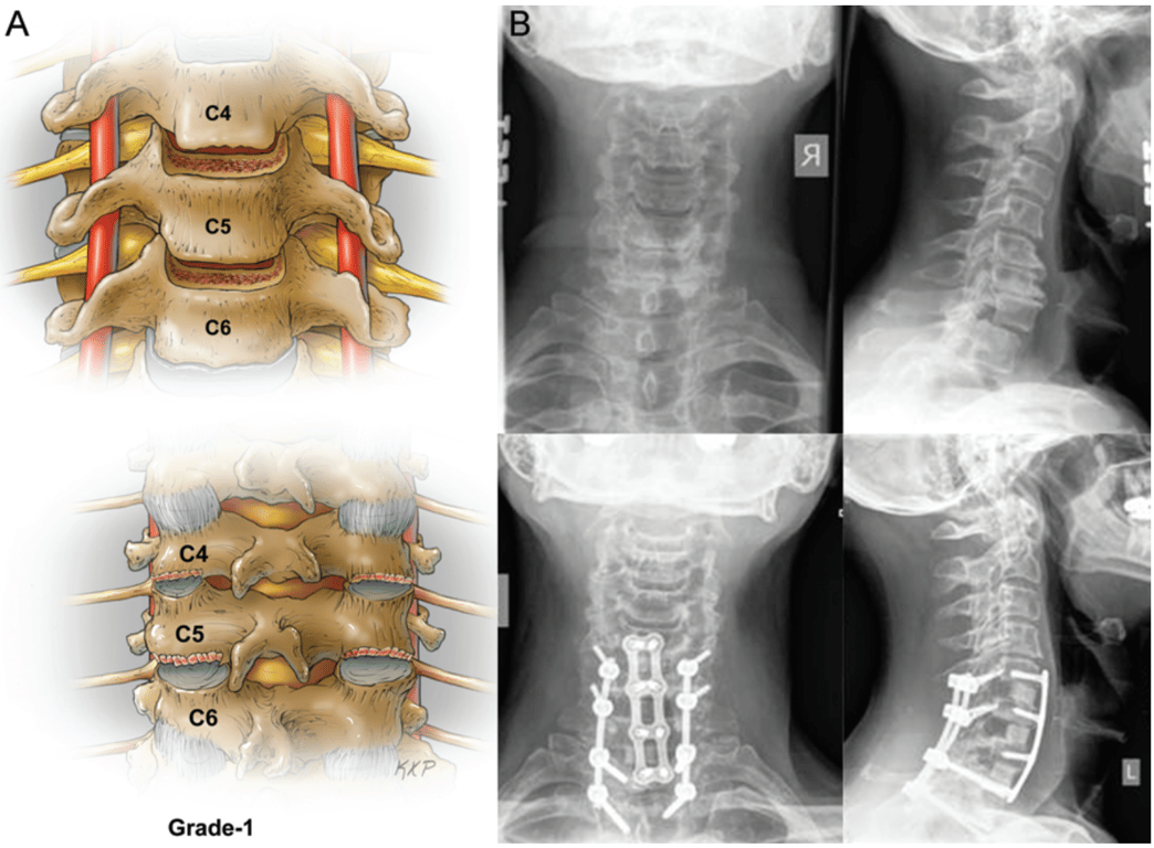 Preoperative and postoperative radiographs of a patient treated with a 3-stage procedure. Stage 1 entailed partial facet resections from C-5 to T-1, C6–T1 laminectomies, and posterior segmental instrumentation and fusion from C-5 to T-2. Stage 2 involved an anterior cervical discectomy and fusion with plating from C-5 to T-2. Stage 3 necessitated placement of rods, final posterior correction, and posterior spinal fusion from C-5 to T-2.