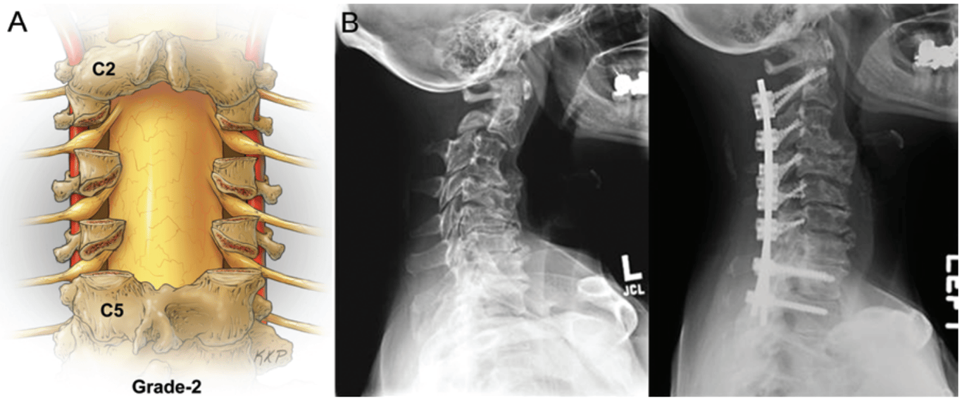 A: Grade 2 osteotomy, complete facet joint/Ponte osteotomy. 
B: Preoperative and postoperative radiographs of a patient treated with multilevel complete facet resection and posterior segmental instrumentation and fusion from C2–T2. The classification for this case is 2P (with no minor osteotomies).