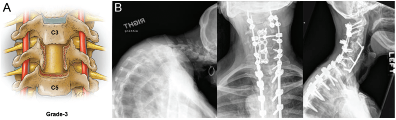 A.: Grade 3 osteotomy, partial or complete corpectomy. 
B: Preoperative and postoperative radiographs of a patient treated with a 3-stage procedure. Stage 1 entailed complete facet resection from C-4 to T-4, posterior segmental instrumentation from C-1 to T-6, and foraminotomies at C-2 to C-3 and C7–T1. Stage 2 involved C-4 corpectomy and anterior cervical discectomy and fusion with plating from C-3 to C-7. Stage 3 necessitated posterior rod placement, final correction, and fusion from C-1 to T-6. The classification for this case is 3PAP (with Grade 2 minor osteotomies).