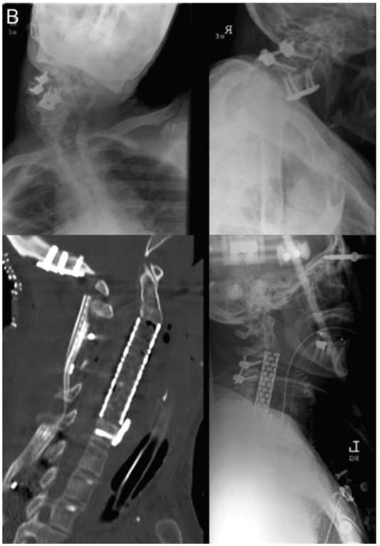 Preoperative and postoperative radiographs of a patient treated with a 2-stage procedure. 
Stage 1 involved anterior removal of instrumentation, corpectomy through the uncovertebral joints to the transverse foramen bilaterally, and anterior fusion with cages placed from C-2 to C-6. 
Stage 2 entailed posterior removal of instrumentation, spinal fusion with instrumentation from the occiput to T-2, and posterior laminectomy and complete facet resection at C-3 to C-4. 
The classification for this case is 7AP (with no minor osteotomies).