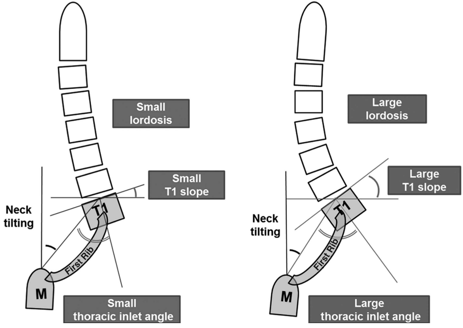 An illustration of the relationship between TIA, T1 slope, and CL. 
A small TIA yields a low T1 slope and therefore less CL is required to balance the head over the thoracic inlet and trunk. 
Conversely, a large TIA yields a greater T1 slope so that a greater magnitude of CL is required to balance the head over the thoracic inlet and trunk. 
CL indicates cervical lordosis; TIA, thoracic inlet angle.