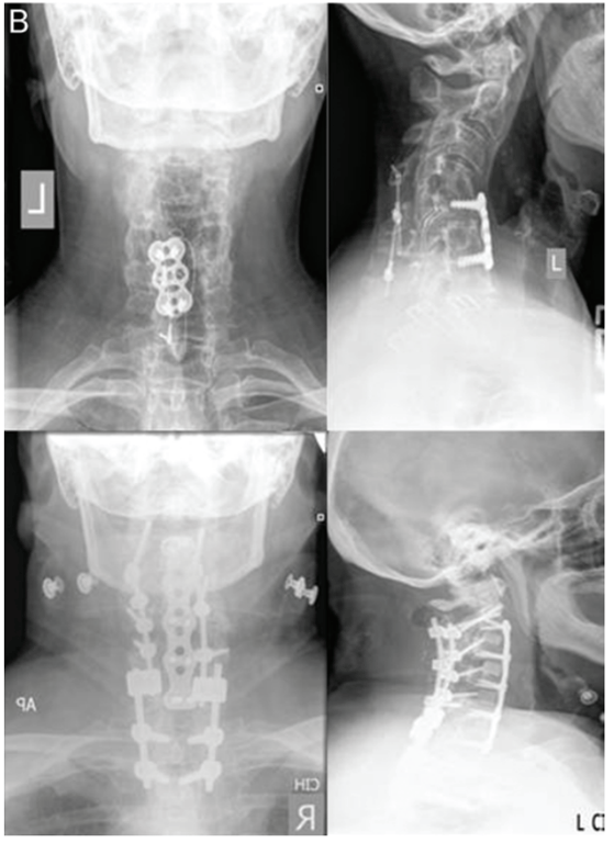 Preoperative and postoperative radiographs of a patient treated with a 3-stage procedure. 
Stage 1 entailed posterior instrumentation removal, exploration of fusion, C3–7 laminectomy, complete facet resections from C-3 to C-5, and segmental instrumentation from C-2 to T-1. 
Stage 2 involved removal of anterior instrumentation, multilevel discectomy and osteotomy through the uncovertebral joints to the transverse foramen, and plating from C-3 to C-7. 
Stage 3 necessitated posterior rod placement, final correction, and fusion from C-2 to T-1. 
The classification for this case is 4PAP (with Grade 2 minor osteotomies).