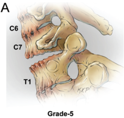 Grade 5 osteotomy, opening wedge osteotomy.