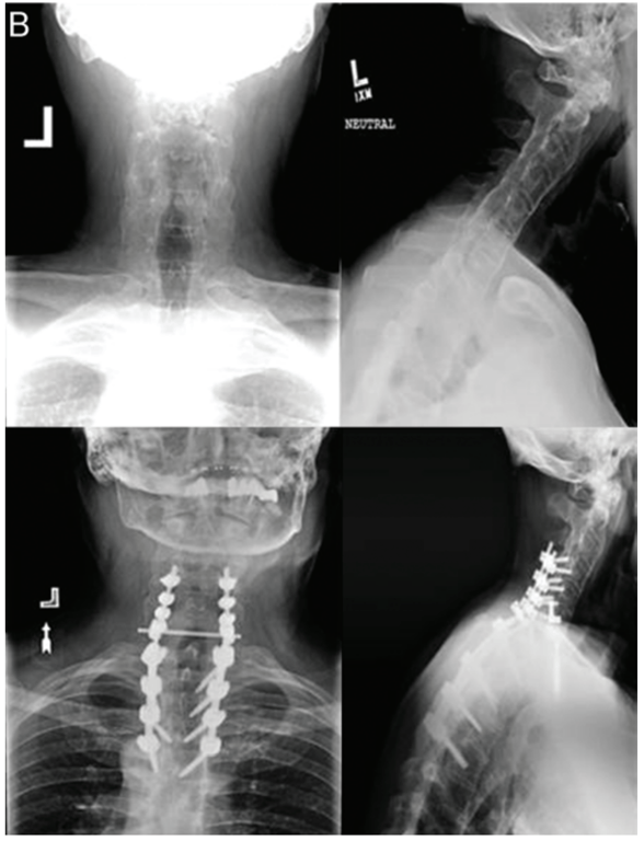Preoperative and postoperative radiographs of a patient treated with posterior segmental instrumentation from C-4 to T-5, C6–T1 laminectomy, opening wedge osteotomy at C-7, rod placement, and reduction of deformity. 
The classification for this case is 5P (with no minor osteotomies).