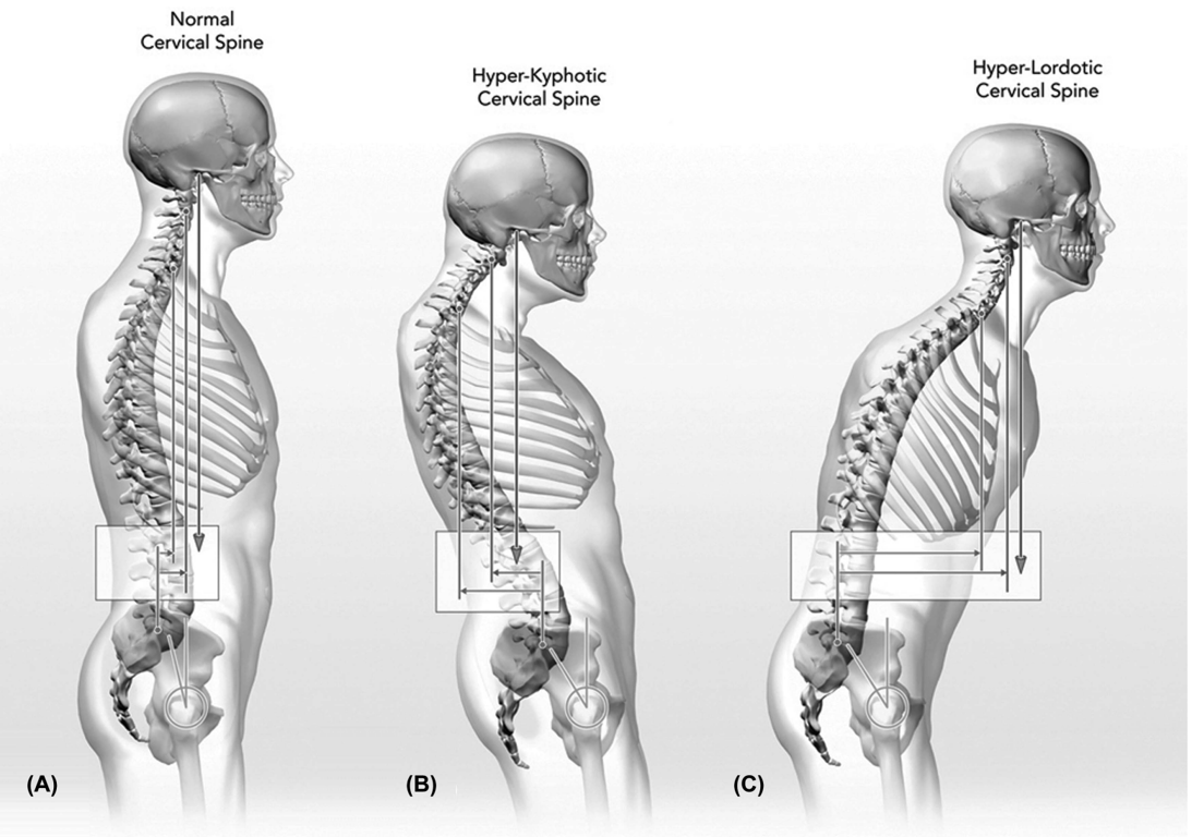Proper sagittal alignment facilitates posture maintenance A, and poor alignment can lead to compensatory mechanisms that alter alignment parameters of the cervical spine B and C.
An elevated PT is produced by either cervical kyphosis or global sagittal malalignment but PT due to cervical kyphosis is usually accompanied by lumbar hyperlordosis. 