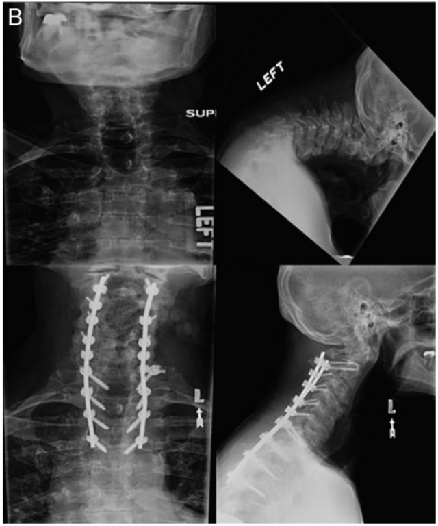 Preoperative and postoperative radiographs of a patient treated with posterior segmental instrumentation from C-2 to T-4, laminectomy from C-2 to T-1, pedicle subtraction osteotomy at C-7, and Smith-Petersen osteotomies at C6–7 and C7–T1. The classification for this case is 6P (with
Grade 2 minor osteotomies).