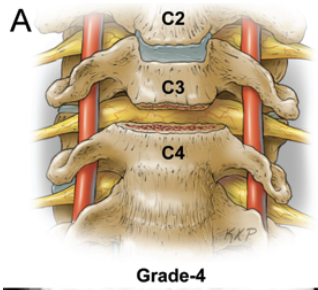 Grade 4 osteotomy, complete uncovertebral joint resection to transverse foramen.