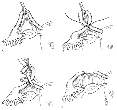 If faster reabsorption → No recanalization (Plain catgut → modified Pomeroy)

Chromic catgut → Recanalization
