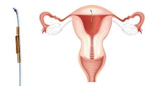 Sutured into myometrium in Nulliparous woman