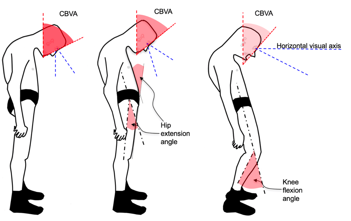 Clinical analysis of global and cervical deformity using the chin–brow vertical angle (CBVA) and assess- ment of hip extension angle in standing position with knees extended (left and middle). Patients are asked to flex at the knees to achieve horizontal visual axis and the knee flexion angle is assessed
