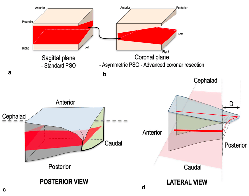 Graphs illustrate concept and implications of asymmetric closing-wedge-type osteotomies. 
Resection gap for asymmetric osteotomy in a sagittal plane and b coronal plane, also shown in patients with deformed vertebrae at osteotomy level: 
c sagittal plane and d coronal plane