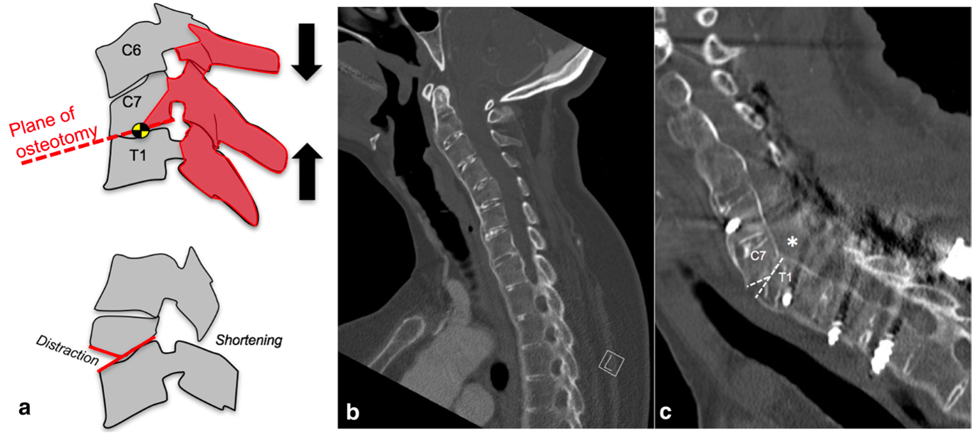 Illustration of Y-Type opening–closing wedge osteotomy. 
a Concept. 
b Preop CT scan in AS patient. 
c Postop CT scan shows anterior opening and endplates gapping with posterior osteotomy closure and osseous approximation of endplates C7–T1