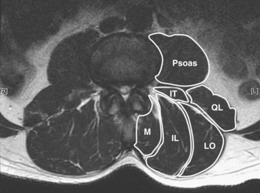 multifidus (M), iliocostalis (IL), longissimus (LO), quadratus lumborum (QL), intertransversarii (IT), and psoas muscle
