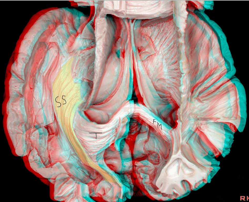 Superior view: T- Tapetum, SS- Sagittal Striatum, FM- Forceps Major 