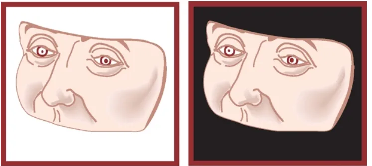 ΤΟ DlSTlNGlJlSH ςιΜΡΙΕ ΑΝΙςοτ:ολΙΑ ΑΝΟ TiJRN 0FF ΤΗΕ LlGHTS ΙΝ ΤΗΕ EXAMlNlNG ROOM. 1F ΤΗΕ SMALlER ΡυΡΙΙ ις ΤΗΕ ABNORMAL ΟΝΕ. HORNER SYNOROME. ΤΗΕΝ ΤΗΕ ANlsocORlA, wlLl BECOME MORE PRONOUNCEO. 