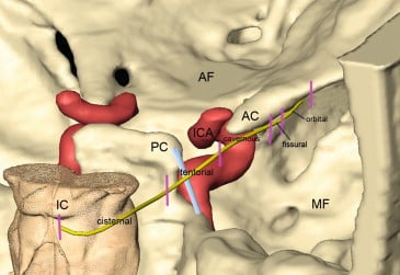 Anatomy of the Trochlear Nerve - ScienceDirect