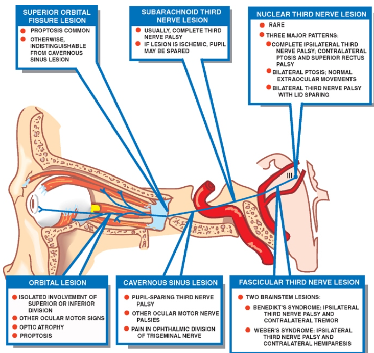 SUPERIOR ORBITAL FISSURE LESION . PROPtos.s couvoN • OTHERWISE. FRO" CAVERNOUS ORBITAL LESION ISOLATED BVOLVEMENT OF supemoR OR INFERIOR O' VLSI ON • OTHER OCULAR MOTOR SIGNS • OPTIC ATROPHY • PROPToes SUBARACHNOID THIRD NERVE LESION usual COMPLETE THRO NERVE PALSY IF LESION tscHEwc. pun MAY EE SPARED CAVERNOus SINUS LESION . PUPIL-SPARIW THIRD NERVE • OMER NERVE pa 'SES OF NERVE NUCLEAR THIRO NERVE LESION • THREE MAJOR PATTERNS: • CONPLETE 'PSILATERAL THRO NERVE PALS % CONT R ALATEAAL PTOSIS ANO supEROR RECTus • BILATERAL PTOSts: NORMAL EXTA •OCULAR MOVEMENTS • RAT ERAL THRO NERVE PALSY WITH LID SPAR"" FASCICULAR THIRD NERVE LESION . Two BRAINSTEM LESIONS: THRO NERVE PALSY AND Co W RALATERAL TREMOR WEBER•s THRO NERVE PALSY ANO 