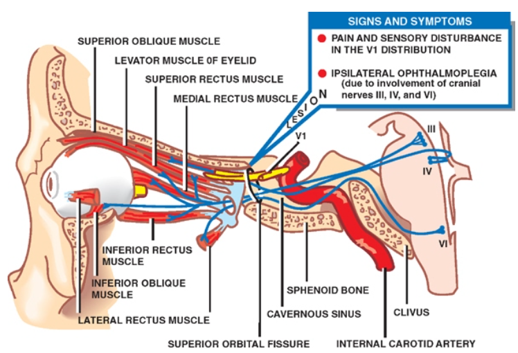 SUPERIOR OBLIQUE MUSCLE LEVATOR MUSCLE OF EYELID SUPERIOR RECTUS MUSCLE MEDIAL RECTOS MUSCL INFERIOR RECTOS MUSCLE *ERIOR OBLIQUE SIGNS AND SYMPTOMS • PAIN AND SENSORY DISTURBANCE IN THE VI . IPSILATERAL OPHTHALMOPLEGIA (due to involvement ot cranial nerves and o SPHENOID BONE MUSCLE CAVERNOUS SNUS LATERAL RECTOS MUSCLE SUPERIOR ORBITAL FISSURE INTERNAL CAROTID ARTERY 