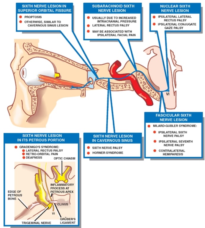 SIXTH NERVE LESION IN SUPERIOR ORBITAL FISSURE • PRO" oss • OTHERWISE. TO SWUS SIXTH NERVE LESION IN ITS PETROUS PORTION • LATERAL RECVus PALSY OPTE CHAS u MLA AT SUBARACHNOID SIXTH NERVE LESION INTRACRANIAL PR ESM.m LATERA L RECTuS PALSY NERVE LESION IN CAVERNOUS SINUS SXTH NERVE PALSY NUCLEAR SIXTH NERVE LESION IPSO 'ERAL LME RAL •LATERAL GAZE PALSY FASCICULAR sixrH NERVE LESION SYNDROME ; NERVE tpsn.ATERAL NERVE PALSY HEWPAREsts 