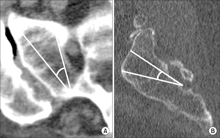 (A) The lateral trajectory of the S2 alar screw varied somewhat among patients but was typically between 30 and 35 degrees in the lateral planes. It did not penetrate the sacroiliac joint laterally or the S1 ventral foramen medially. (B) The superior trajectory of the S2 alar screw was a longer screw insertion and did vary somewhat among patients, but was typically between 15 and 20 degrees in the superior planes. It did not penetrate the anterior cortex as this could cause impingement of the L5 nerve root and injury to the internal iliac vessels.