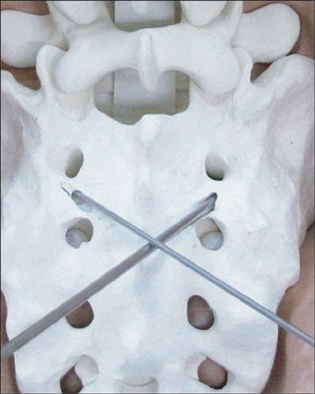Entry point of the S2 alar screw (arrow) and the midpoint of the line from the medial margin of the S1 dorsal foramen and the medial margin of the S2 dorsal foramen.