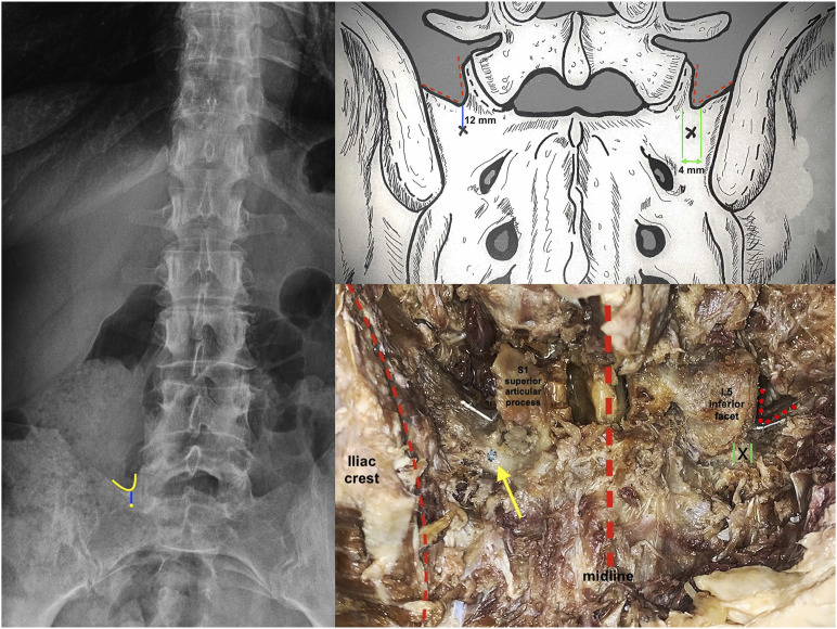 The left image is an anteroposterior radiograph of the spine highlighting the “V” sign on the right side (yellow curve) along with the entry point (yellow dot) for S1 pedicle screw insertion. The upper right image is a drawing (by C. Tannoury) of the posterior view of a male’s sacrum, including the “V” sign (red dotted lines), the inferior entry point (marked by an “X”), and the medial-lateral axis (green lines). The blue line represents the distance between the “V” sign and the entry point. The lower right image is a photograph of a cadaveric specimen. On the left side, the entry point is marked by a lead dot (yellow arrow) inferior to the “V” metallic wire; the L5 inferior facet was dissected and removed to highlight the S1 superior articular process. On the right side, the L5 inferior facet was preserved, the “V” metallic wire is highlighted by red dotted lines, and the entry point is marked by an “X” (medial-lateral axis; green lines).