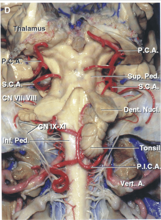 Posterior view after removing all of the cerebellum except for the right tonsil and dentate nucleus