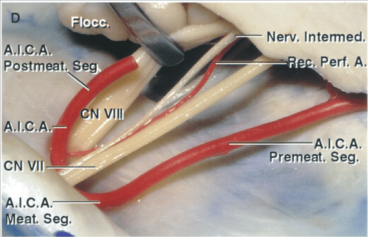 Enlarged view of right AICA