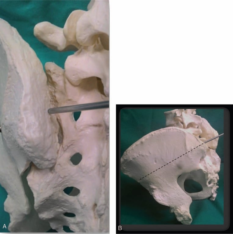 The subcrestal iliac screw entry point is location 2 to 3 cm caudal to PSIS. This point lies 1.5 to 2 cm underneath the iliac crest and above the SI joint allowing screw head to be concealed (A). The trajectory is 45° caudally and laterally towards the anterior inferior iliac spine (dotted line) (B).
