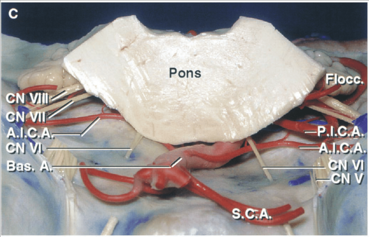 The brainstem section has been extended downward to the midpons. The CN5, CN3, and CN4 have been divided so that the brainstem could be reflected backward to expose the AICA and the CN7 and CN8.