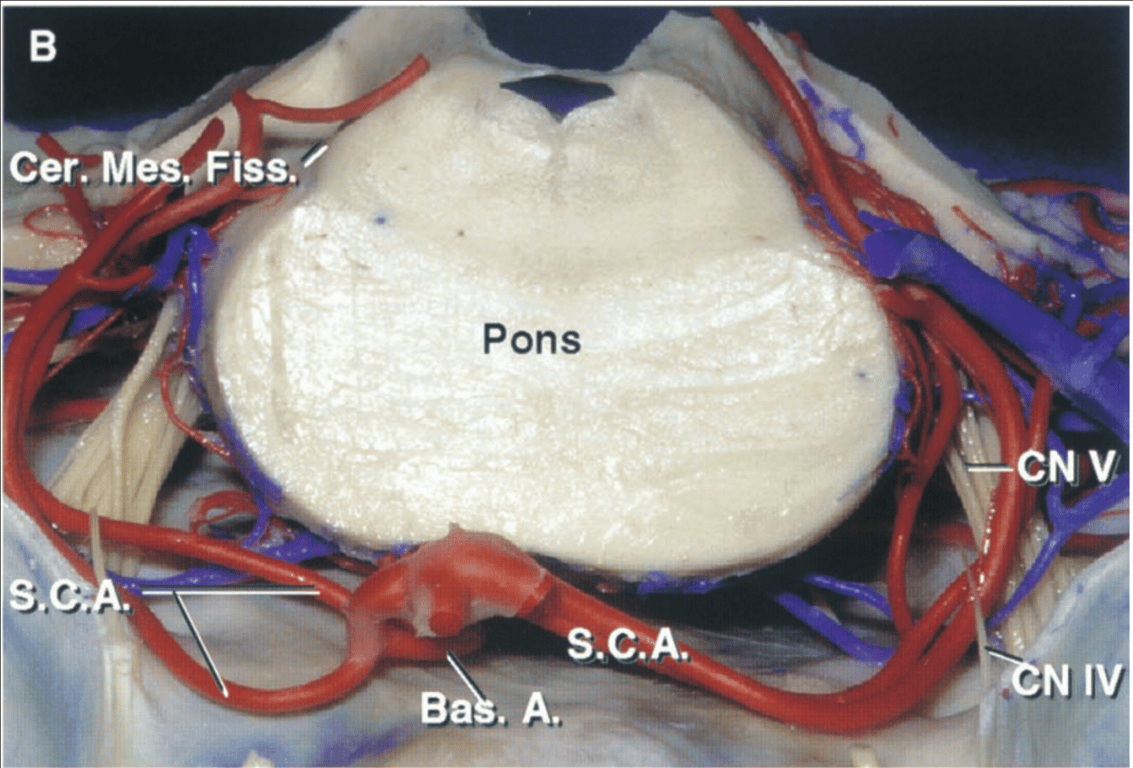 The level of the brainstem section has been extended downward to the pons. 