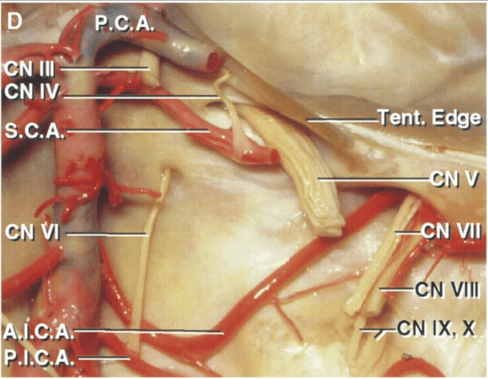 The cerebellum and brainstem have been removed to show the relationship of the AICAs to the cranial nerves and internal acoustic meatus. 