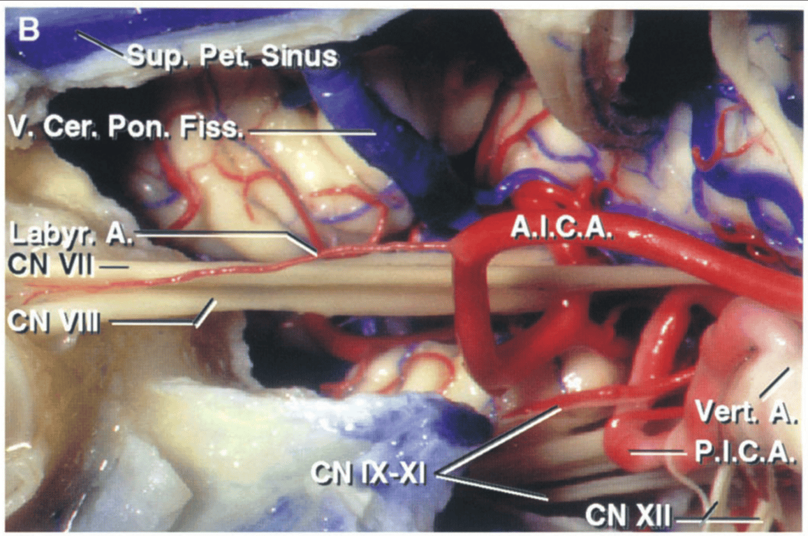 Enlarged view of the right cerebellopontine angle