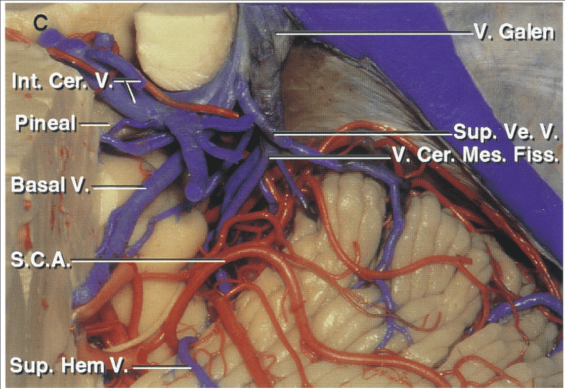Lateral view of the cerebellomesencephalic fissure