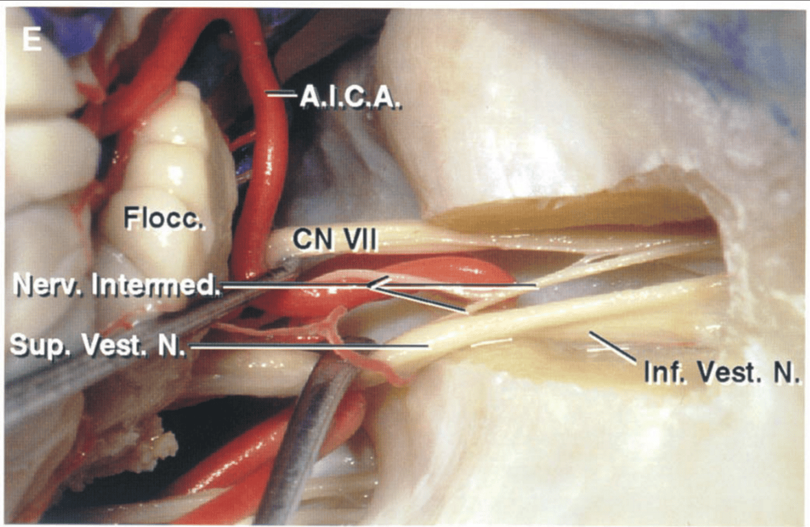 The meatal dura has been opened and the vestibulocochlear nerve displaced downward to expose the facial nerve coursing anterior and superior within the meatus. 