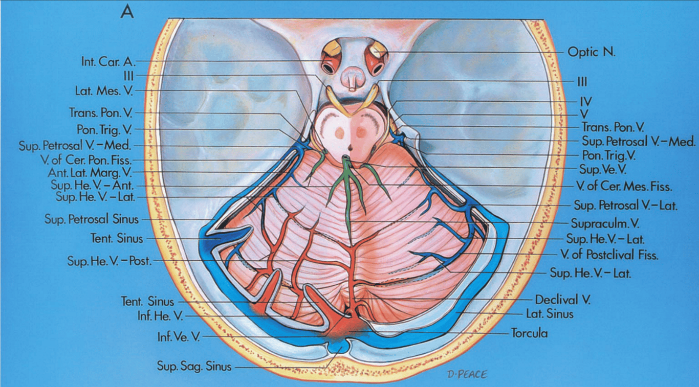 Tentorial surface, superior view. The tentorium has been removed except in the area of the tentorial sinuses.